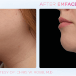 Emface before and after photo