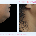 Emface before and after photo