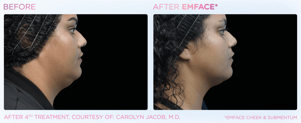 Emface before and after photo