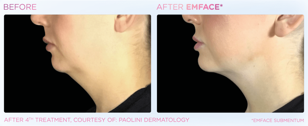 Emface before and after photo