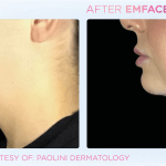 Emface before and after photo