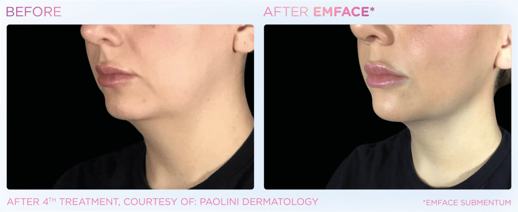 Emface before and after photo