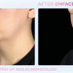Emface before and after photo