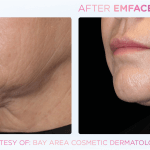 Emface before and after photo