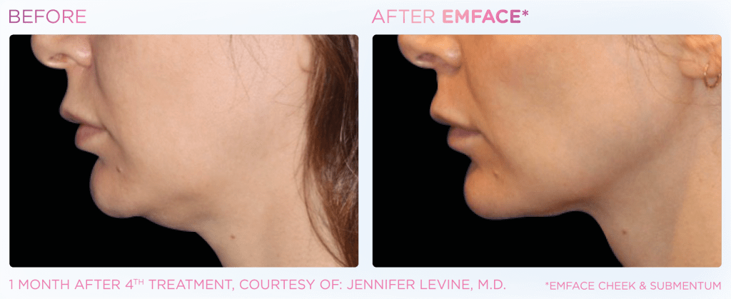 Emface before and after photo