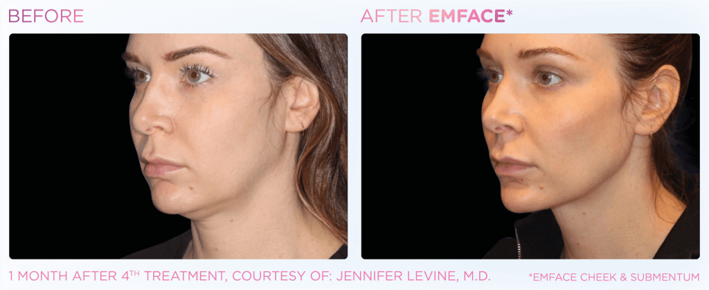 Emface before and after photo