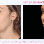 Emface before and after photo