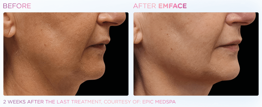 Emface before and after photo