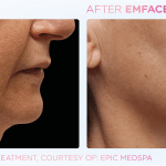 Emface before and after photo
