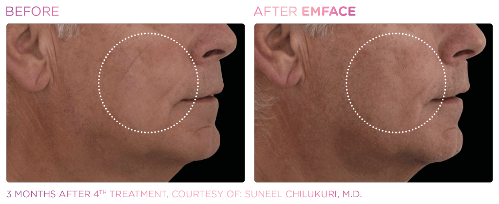 Emface before and after photo