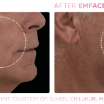 Emface before and after photo