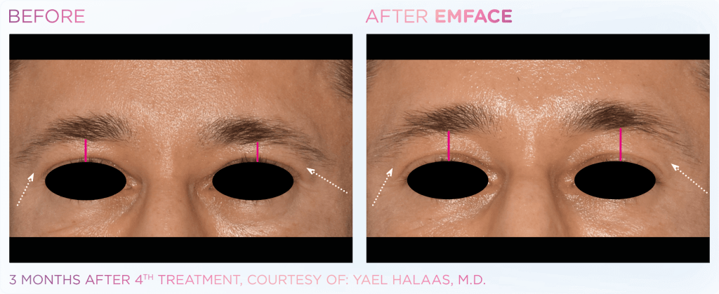 Emface before and after photo