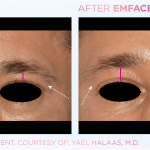 Emface before and after photo