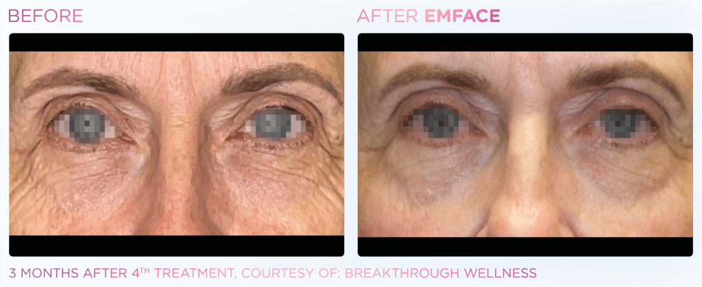 Emface before and after photo