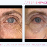Emface before and after photo
