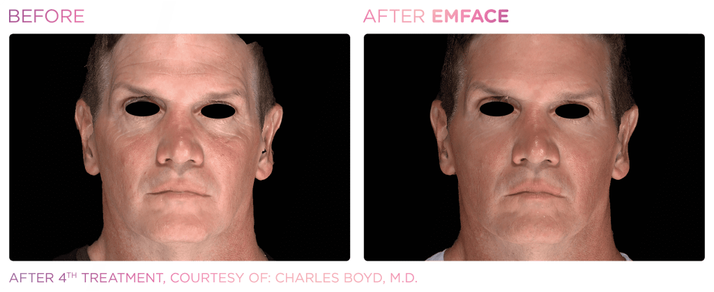 Emface before and after photo