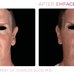 Emface before and after photo