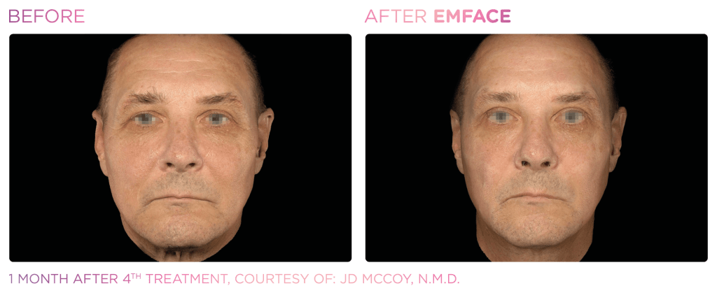 Emface before and after photo