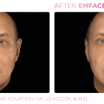 Emface before and after photo