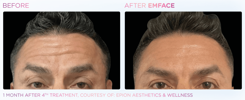 Emface before and after photo