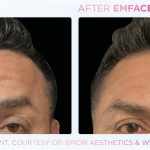 Emface before and after photo
