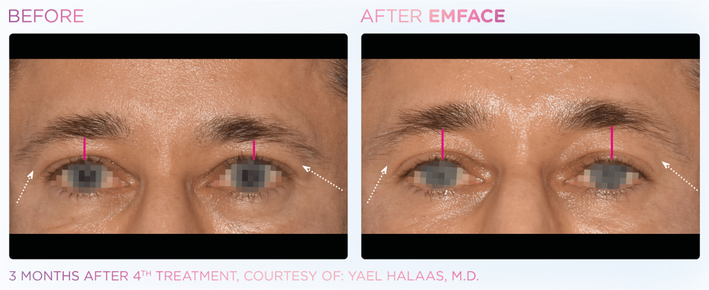 Emface before and after photo