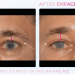 Emface before and after photo