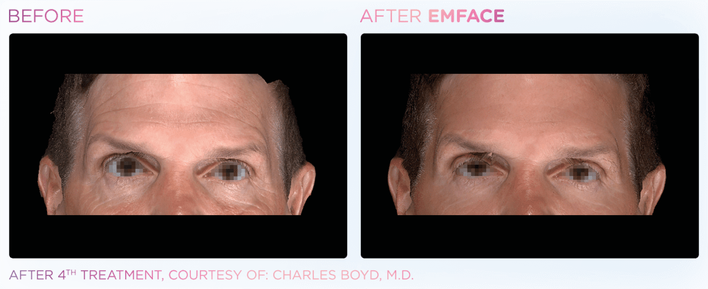 Emface before and after photo