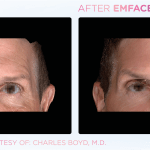 Emface before and after photo