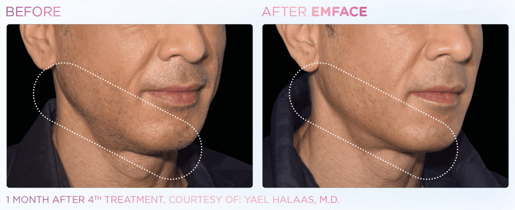 Emface before and after photo