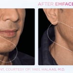 Emface before and after photo