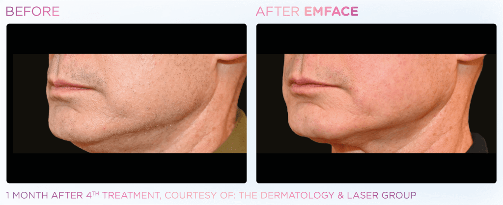 Emface before and after photo