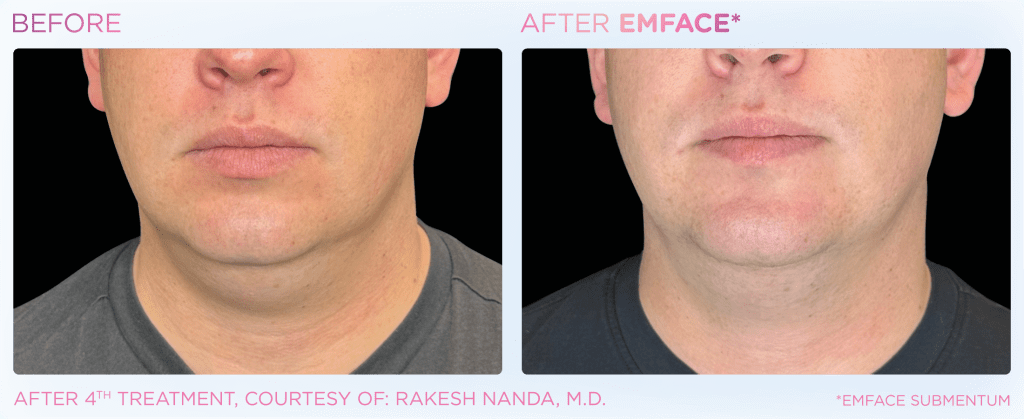 Emface before and after photo