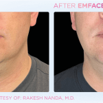 Emface before and after photo
