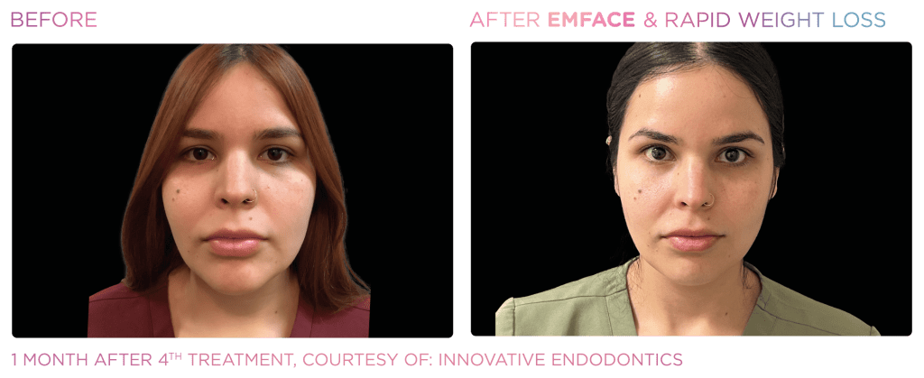 Emface before and after photo