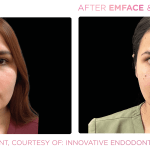 Emface before and after photo