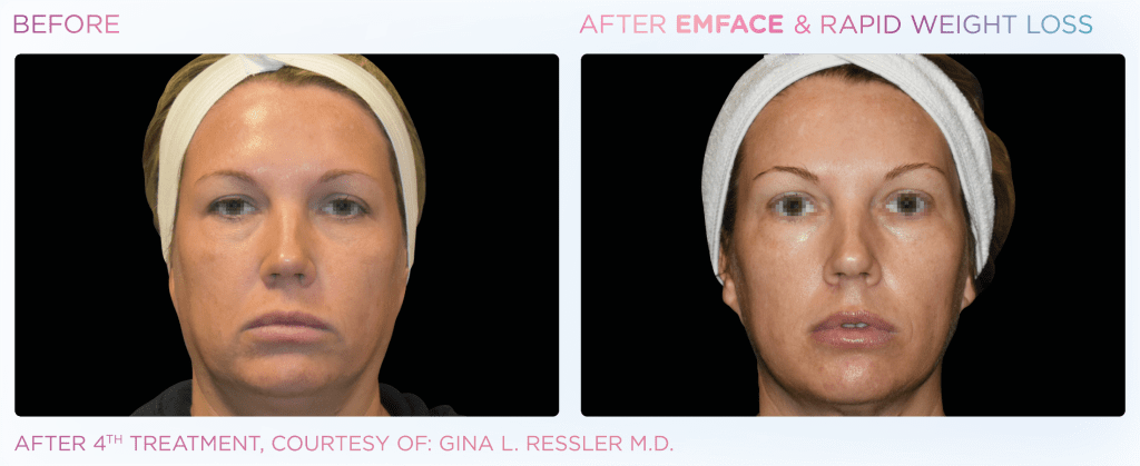Emface before and after photo