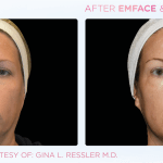 Emface before and after photo