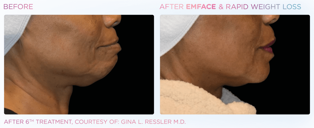 Emface before and after photo