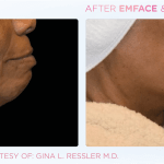 Emface before and after photo