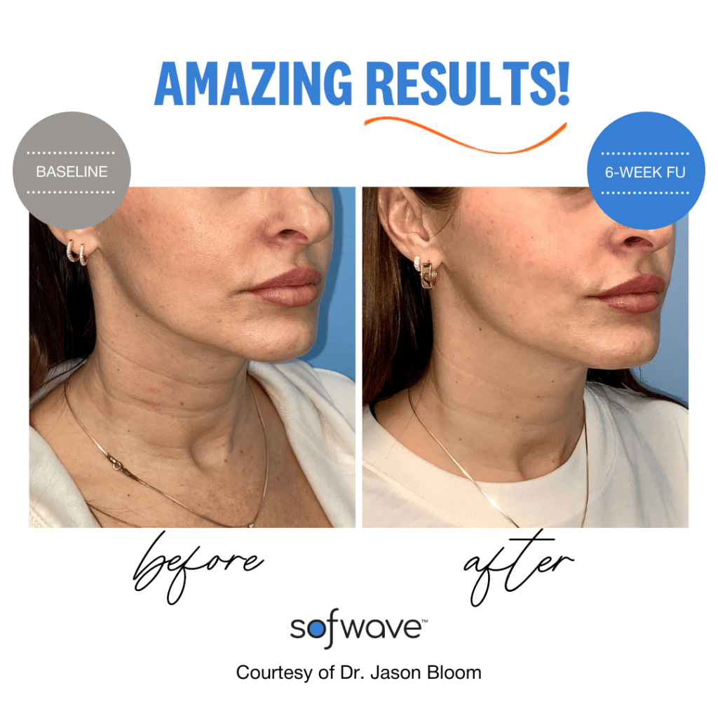 before and after Sofwave™