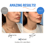 before and after Sofwave™