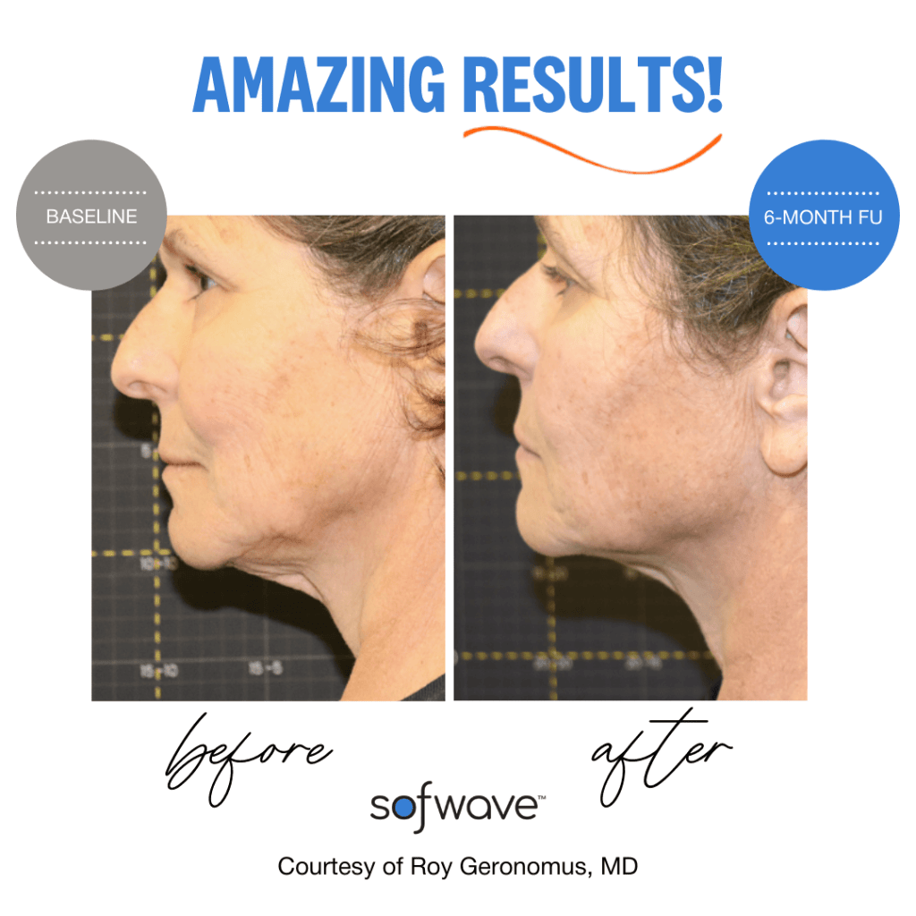 Before & after Sofwave™ Treatment