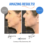 Before & after Sofwave™ Treatment