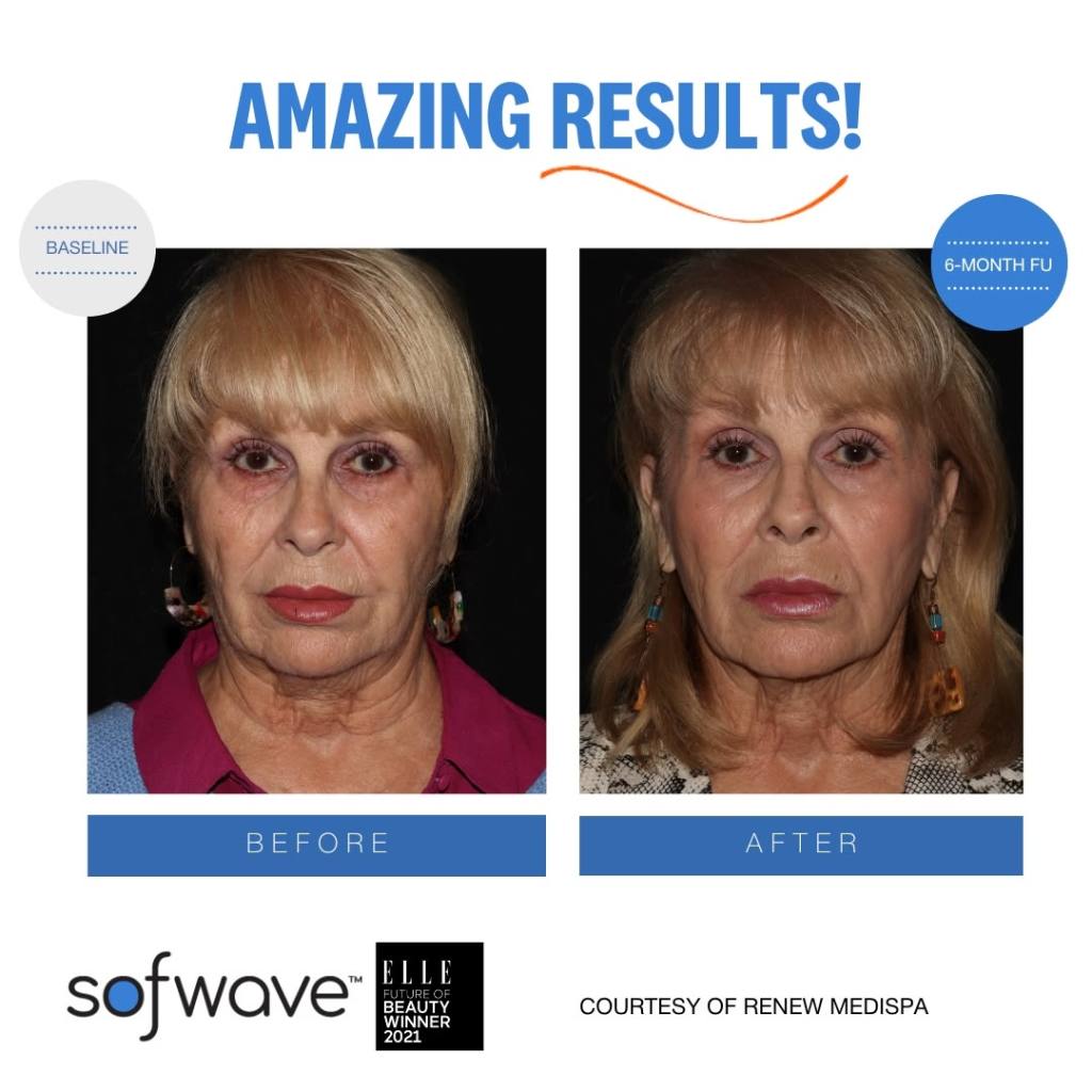Before and After Sofwave™