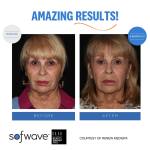 Before and After Sofwave™