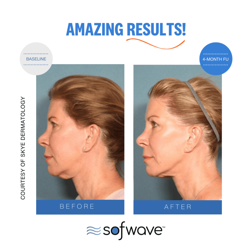 Before and After Sofwave™