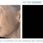 Before & After Photos