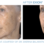 Before & After Photos